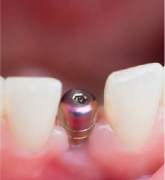 Implantes