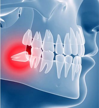 Cirurgia de Siso